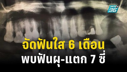 จัดฟันใส 6 เดือน พบฟันผุ-แตก 7 ซี่ | เข้มข่าวค่ำ | 30 พ.ย. 66