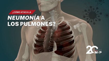 ¿Cómo ataca la neumonía a los pulmones? - #ExclusivoMSP