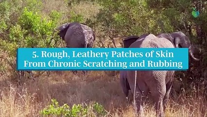 Signs and Symptoms of Eczema