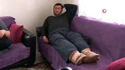 Bacakları tam 80 cm çapına ulaştı! Hastalığın tedavisi yok