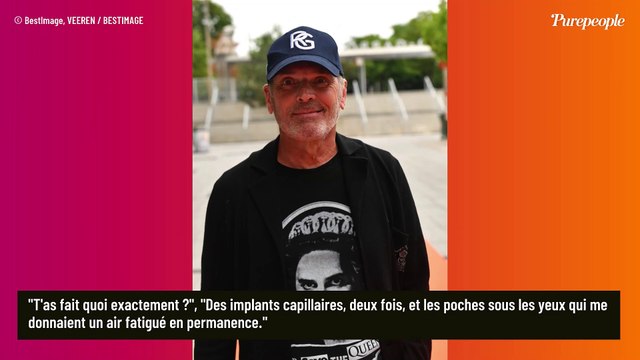 Laurent Baffie métamorphosé à cause de la chirurgie esthétique : révélations sur ses opérations, si on fait les comptes...