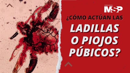 Piojos púbicos: cuando el contacto sexual termina en contagio de liendres - #ExclusivoMSP