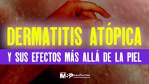 Mejores momentos de “Dermatitis atópica y sus efectos más allá de la piel” - #ExclusivoMSP