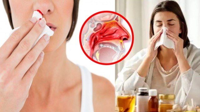 सर्दी में नाक से खून आना | सर्दी में नाक से खून क्यों आता है | Sardi Me Naak Se Khoon Aana | Boldsky