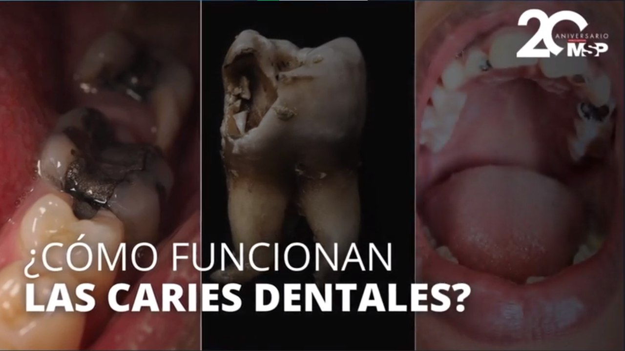 ¿Cómo funcionan las caries dentales y por qué es vital tratarlas? - #ExclusivoMSP
