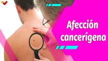 Buena Vibra | Consejos y recomendaciones para protegerte del Cáncer de Piel