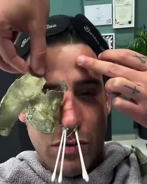 Αυτό πόνεσε! Ο Αναστάσιος Ράμμος έκανε αποτρίχωση στη μύτη και στο πρόσωπο