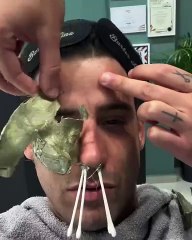 Αυτό πόνεσε! Ο Αναστάσιος Ράμμος έκανε αποτρίχωση στη μύτη και στο πρόσωπο