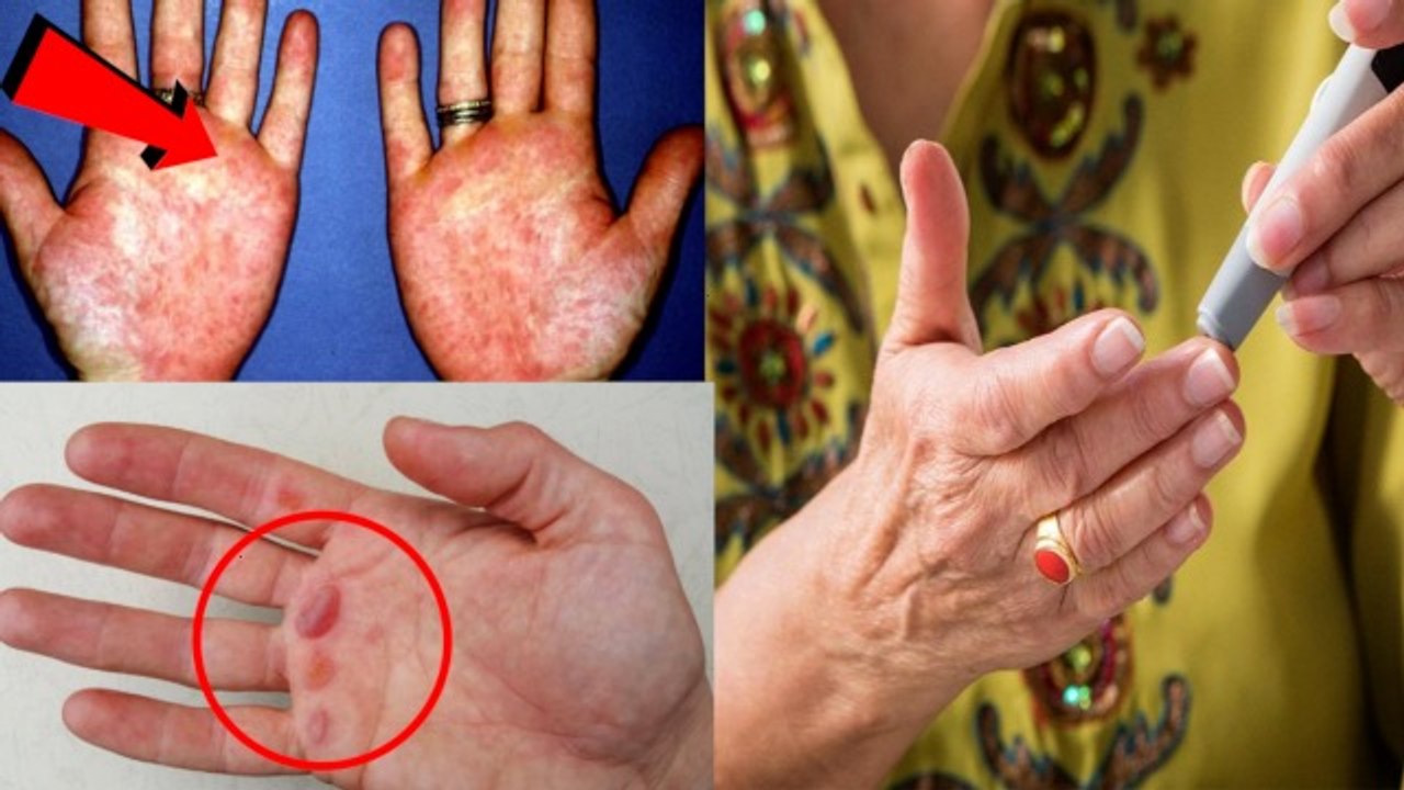 Diabetes Early Signs: Hand Symptoms में High Bl...