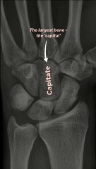 Carpal Bones