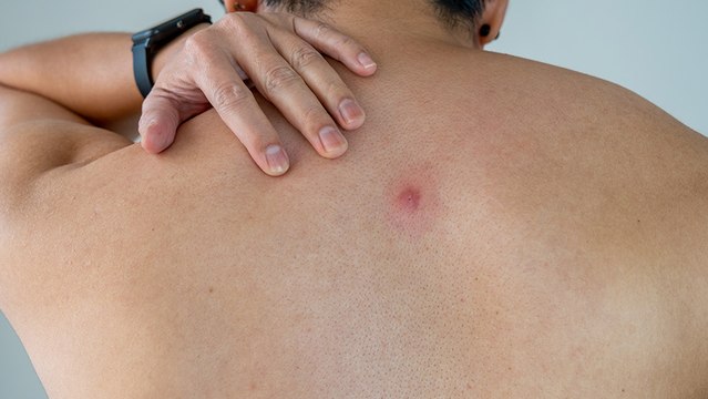 bd-complicaciones-de-abscesos-y-tratamiento-adecuado-121223