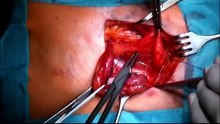 Desarda Hernia inguinal surgery