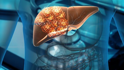 bd-cancer-de-higado-sintomas-deteccion-tratamiento-111223