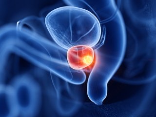 "Le dépistage organisé du cancer de la prostate : quelles raisons expliquent son absence ?