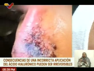 Conozca las recomendaciones y el uso para aplicarse Ácido Hialurónico