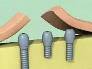 Guide chirurgical implantaire (Surguide Materialise)