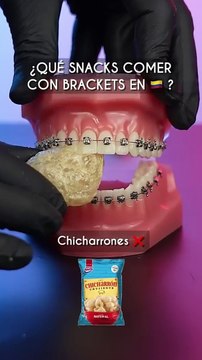 What to eat with brackets in laser dentistry
