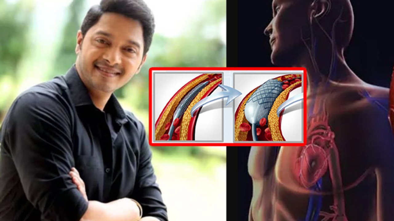 Angioplasty Surgery Kya HaiAngioplasty Surgery Kaise Hota Hai