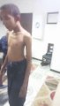 scoliosis حالة شاب من السودان يعاني من احناء العمود الفقري (الجنف)