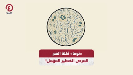 «نوما» آكلة الفم .. المرض الخطير المهمل!
