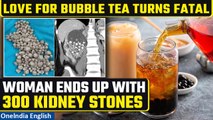 Taiwan woman replaces drinking water with bubble tea, ends up with 300 kidney stones | Oneindia News