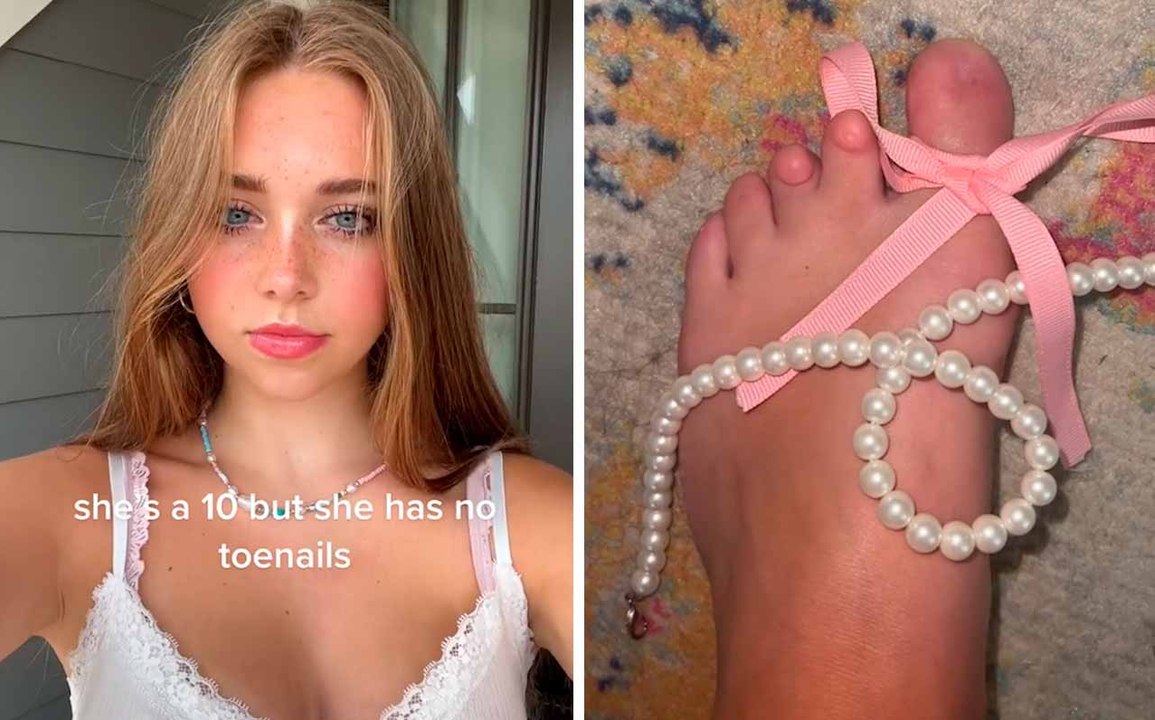 18-vuotias nuori tuli TikTok-kuuluisuudeksi synnyttyään ilman isovarpaan kynttä