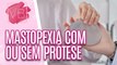 Saiba tudo sobre MASTOPEXIA com ou sem prótese - Você Bonita (19/12/2023)