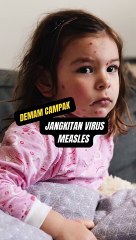 DEMAM campak merupakan salah satu daripada penyakit paling popular yang menjangkiti si kecil sejak beratus tahun lalu