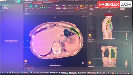 Yapay Zeka, Radyoterapide Kullanılıyor