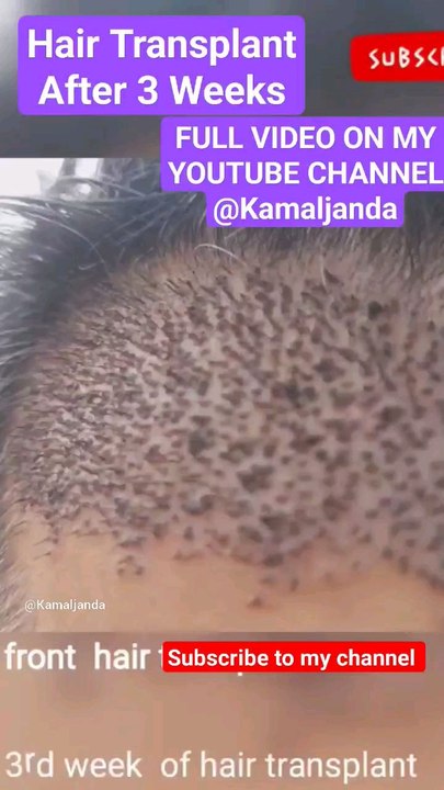 Hair Transplant Experience procedure