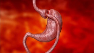 How to Prepare for Gastric Bypass Surgery