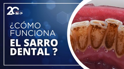 ¿Qué es el sarro dental y por qué es difícil de eliminar? 🦷