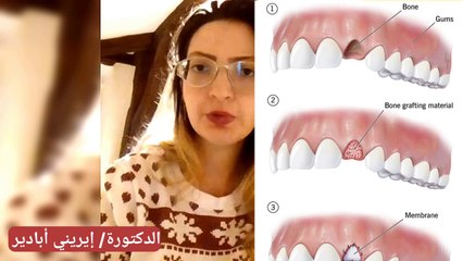 تركيبات الأسنان المتحركة و تآكل عظام الفك الشديد