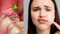 Pericoronitis Treatment At Home: Akal Daad Ke Masude Fulne Ka Ilaj |Wisdom Teeth Gum Swelling Remedy