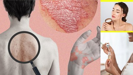 Psoriasis Care In Winter:  क्या सर्दी के कारण एक्जिमा हो सकता है |  Winter Eczema Treatment |Boldsky