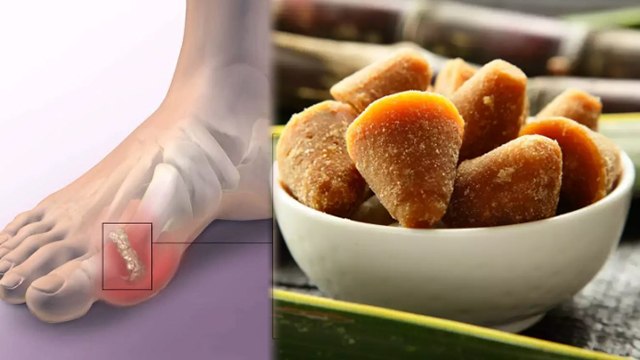 यूरिक एसिड में गुड़ खाना चाहिए या नहीं | Uric Acid Me Gud Khana Chahiye Ya Nahi | Boldsky