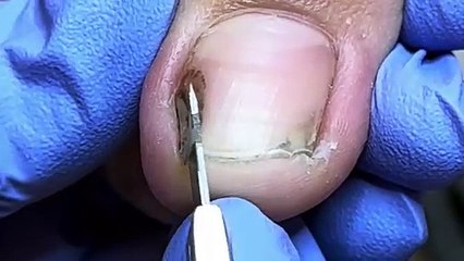 Wow~ Broken toenail with clotted blood hidden underneath【Doctor Liu Pedicure】