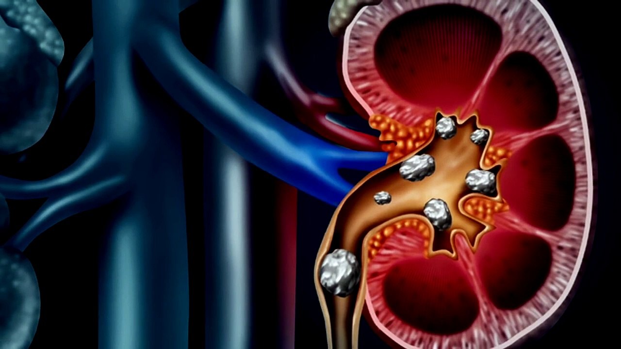 Eliminate Kidney Stones With Lemons Kidney Stone Causes & Lemon Benefits video Dailymotion