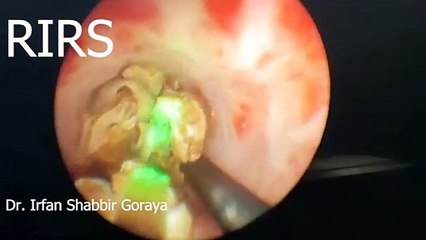 Expert RIRS Treatment by Dr. Irfan Shabbir Goraya – Renowned Urologist