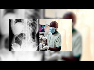 Yasimbutse urupfu: Twaganiriye na Dr Rutaganda wakuye ikiyiko mu nda y'umurwayi