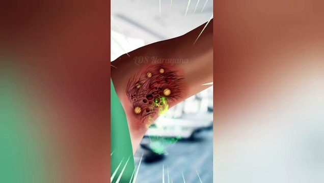 Step-by-Step Guide: Removing Hair from an Infected Armpit