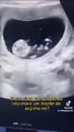 Triplo Choque! Pai desmaia em ultrassom ao descobrir gravidez de trigêmeos