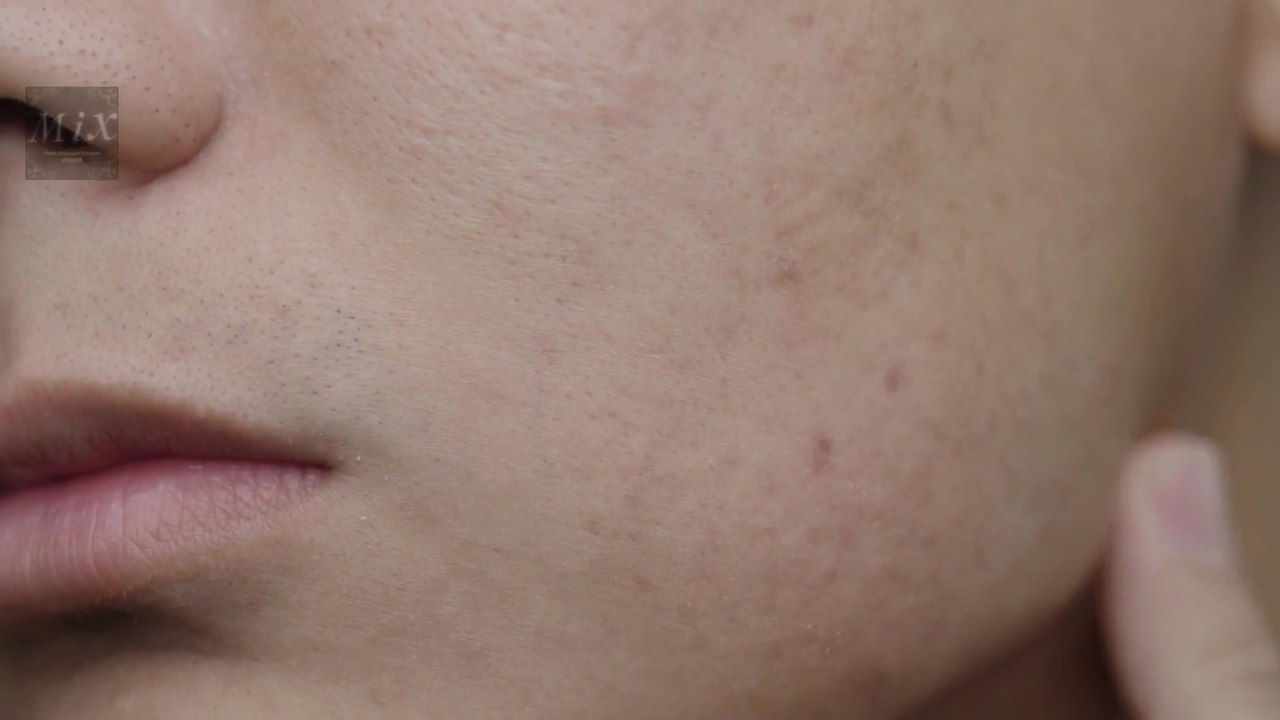 Large pores Myths | Ways to Avoid Large pores