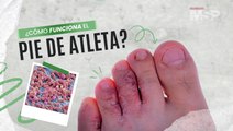 Mal olor, picor y hongos en los pies: así funciona el “Pie de atleta” - #ExclusivoMSP