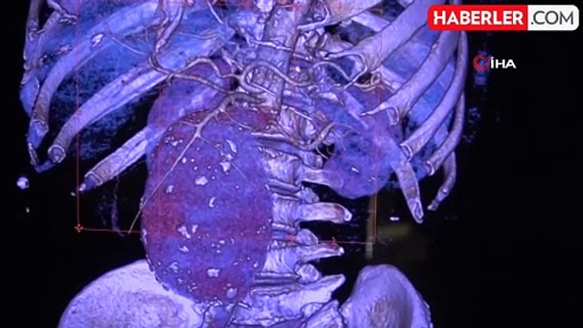 Aort damarı kalp büyüklüğünde şişen hastayı aynı anda 2 ameliyatla hayatta tuttular