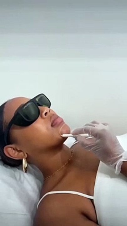 Épilation Laser Candela Nd-Yag : La Solution Idéale pour l'Épilation des Femmes de Couleur Noire
