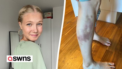 I bruise so badly teachers thought I was being abused as a child - but it was rare condition