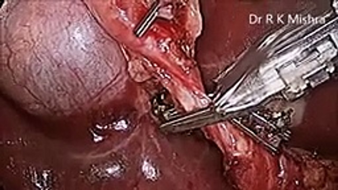 Laparoscopic Cholecystectomy, Sterilization and Appendectomy in same Patient