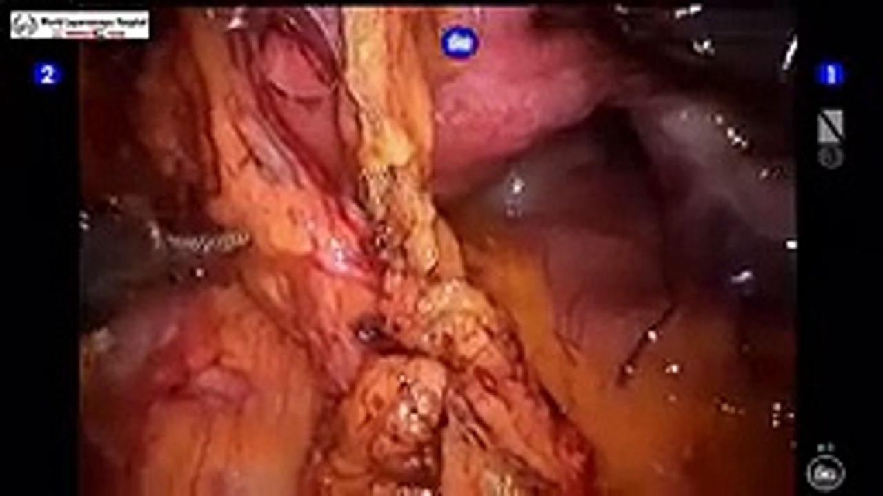 Davinci Robotic Adhesiolysis Surgery with Application of Interceed