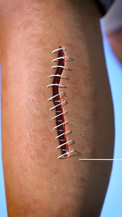 How Stitches Work